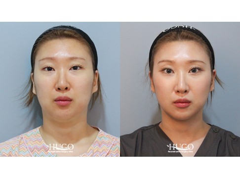 이중턱지방흡입