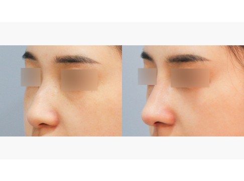 코(실리콘귀연골비중격)+코끝 연장술