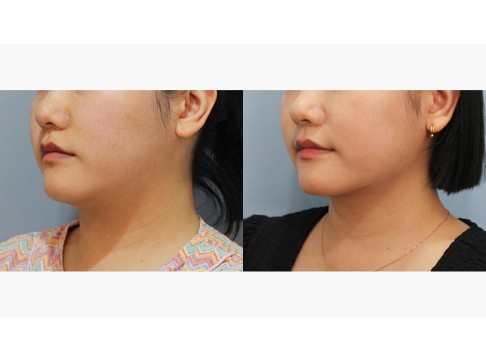 이중턱지방흡입