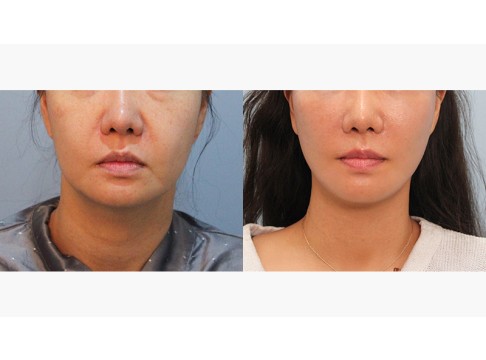 안면목거상+하안검+피치거상+얼굴지방흡입(심술보)