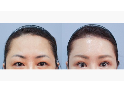 이마거상+상안검