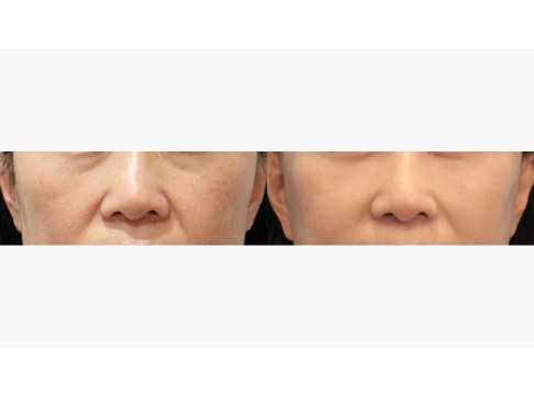 하안검+피치거상