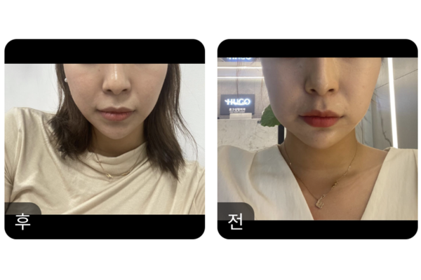 실리프팅 했어요~!