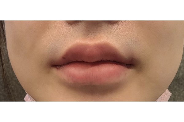 입술필러했어요