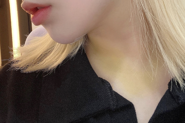 미니거상+이중턱지방흡입(v라인윤곽술/턱밑턱선)+집업거상+심부불 지방제거+실리프팅