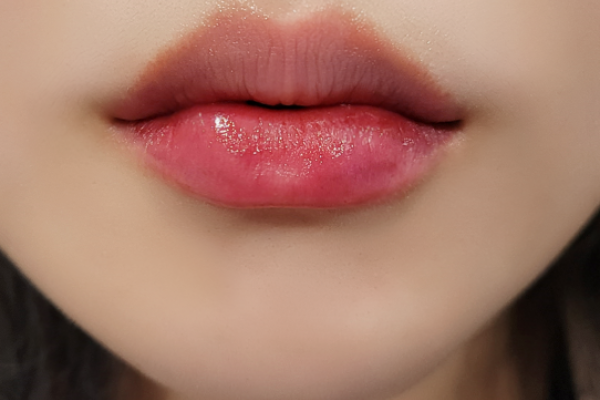 입술 필러 + 입꼬리 필러 해써용