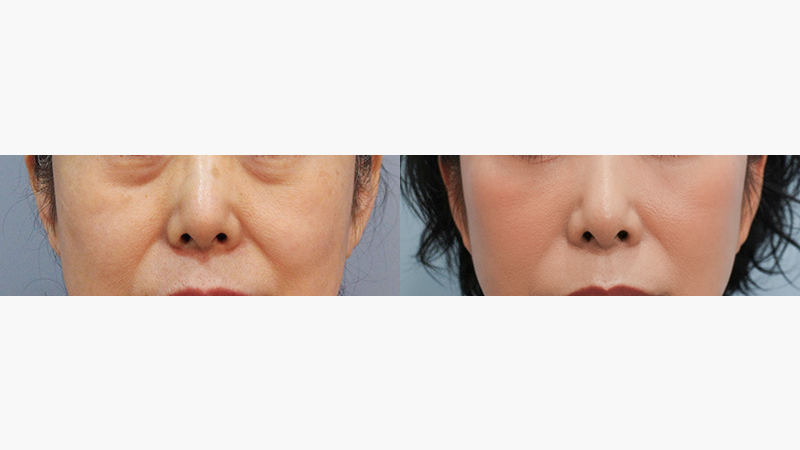 정면