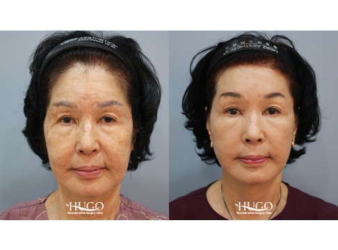안면목거상+이마축소거상+지방흡입