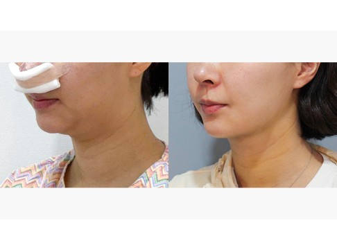 이중턱 지방흡입