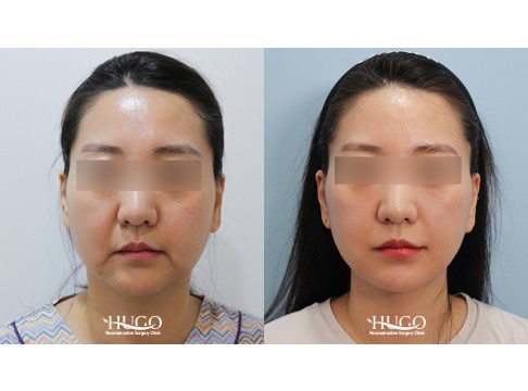 안면목거상+집업거상+지방흡입