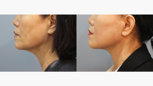 수술 후 3개월차