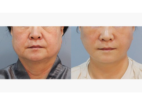 안면거상+하안검+피치거상