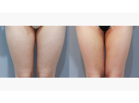 허벅지 지방흡입