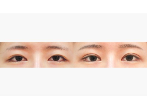절개+눈매교정