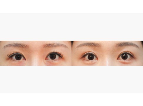 절개+앞트임+눈밑지방재배치