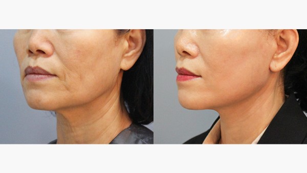 수술 후 3개월차