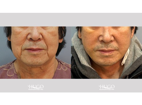 안면목거상,이마거상,하안검,집업거상,지방흡입