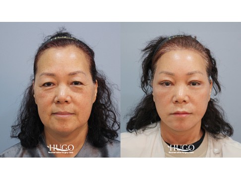 안면목거상+집업거상+이마축소거상+상안검+하안검