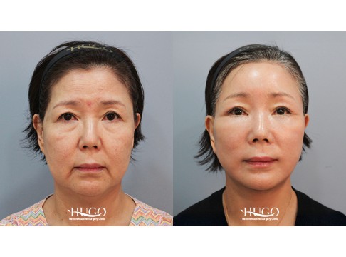 안면목거상+이마거상+집업거상+하안검