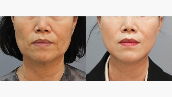 수술 후 3개월차