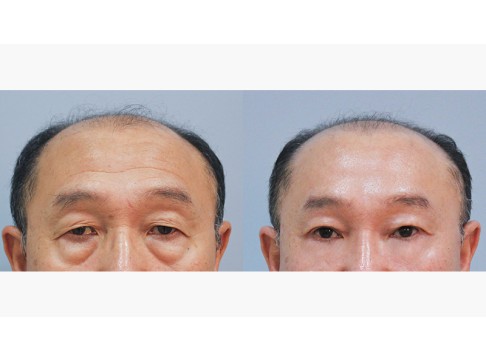 이마거상+상안검+하안검+피치거상
