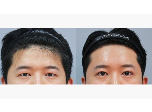 이마거상+상안검