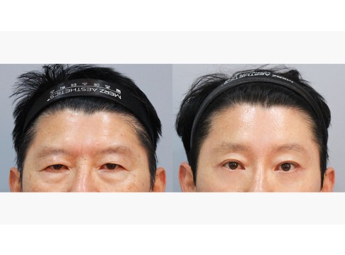 이마거상+상안검+하안검