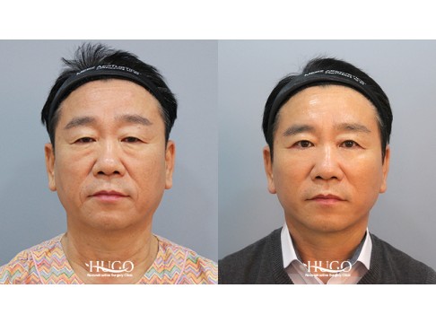 안면목거상+상안검+하안검+피치거상+지방흡입(팔자,심술보,이중턱)