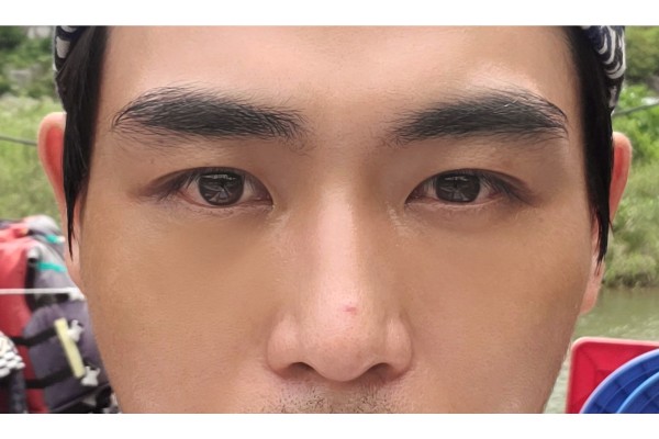 눈밑지방재배치