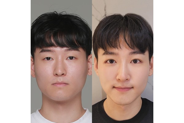 자연유착, 뒤트임, 앞광대 지방이식했어요