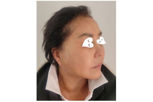 엄마 안면거상 목거상 2주차 후기