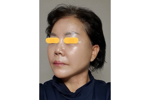 안면거상 1개월차 진짜 대단하네요