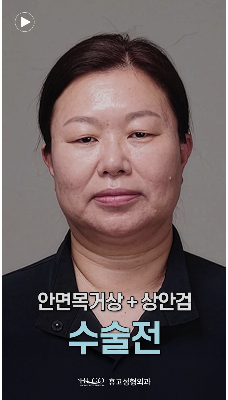 안면거상+목거상+상안검 1개월차 놀라운 전후 변화✨