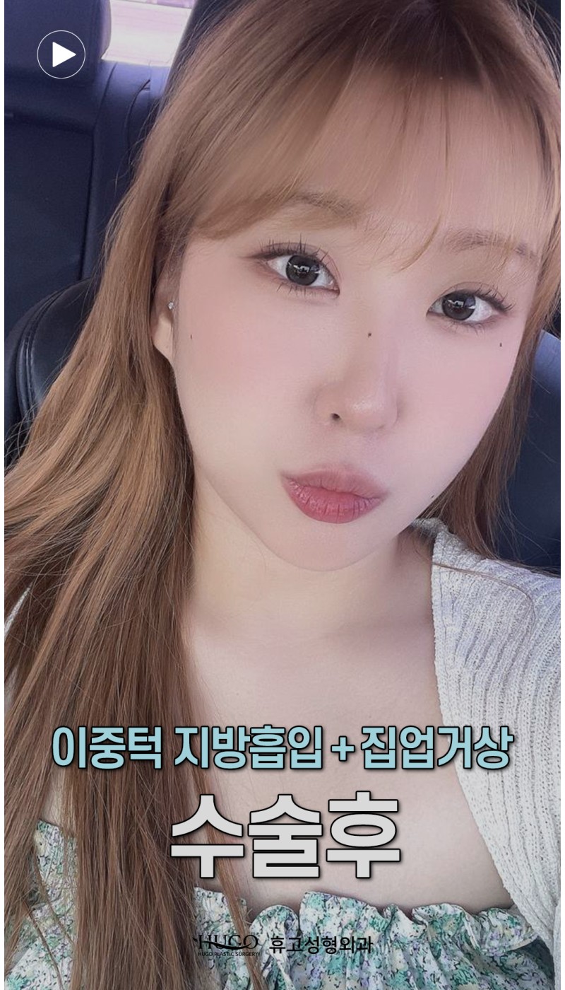 이중턱지방흡입 1개월차 리얼후기????사라진 이중턱! ????